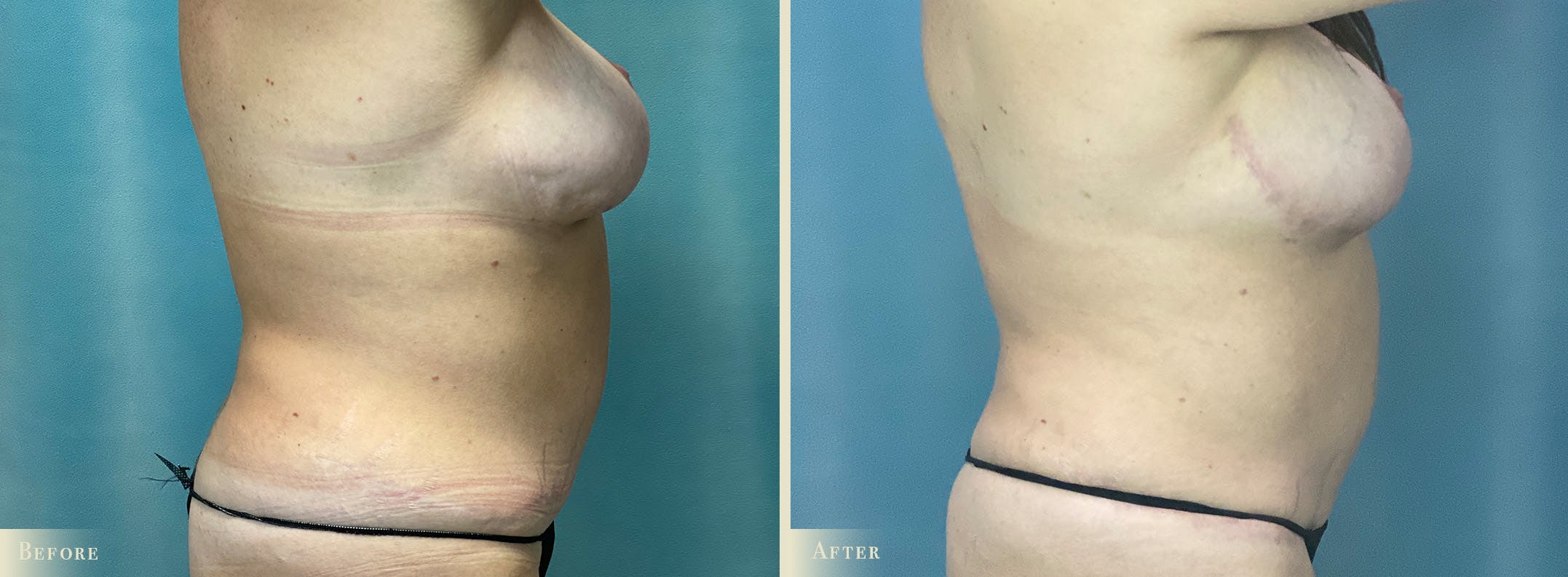 Mini Tummy Tuck Before & After Gallery - Patient 383005 - Image 3