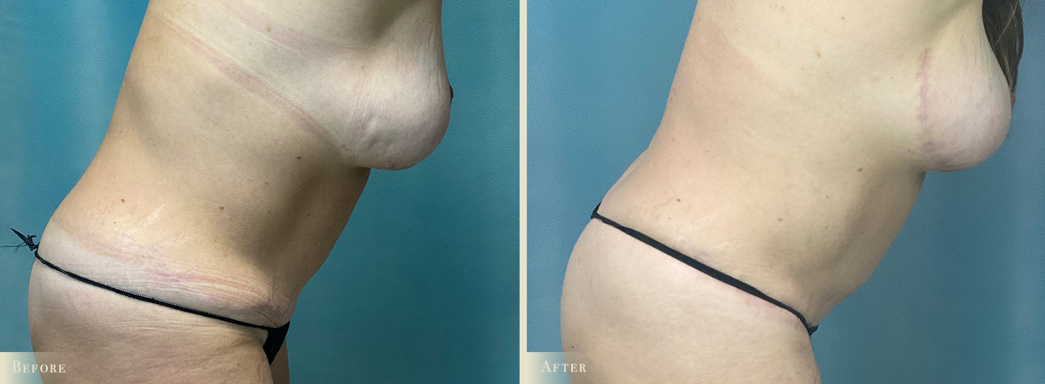 Mini Tummy Tuck Before & After Gallery - Patient 383005 - Image 2