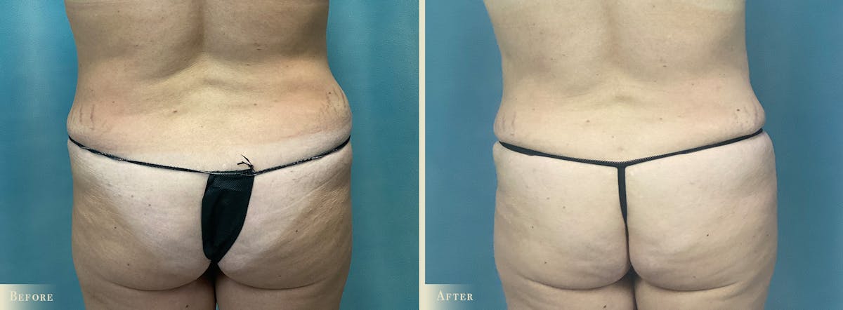 Mini Tummy Tuck Before & After Gallery - Patient 383005 - Image 4