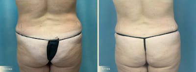 Female Liposuction Before & After Gallery - Patient 237123 - Image 4