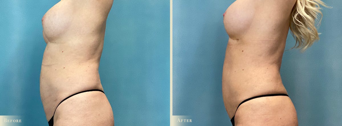 Mini Tummy Tuck Before & After Gallery - Patient 123665 - Image 2