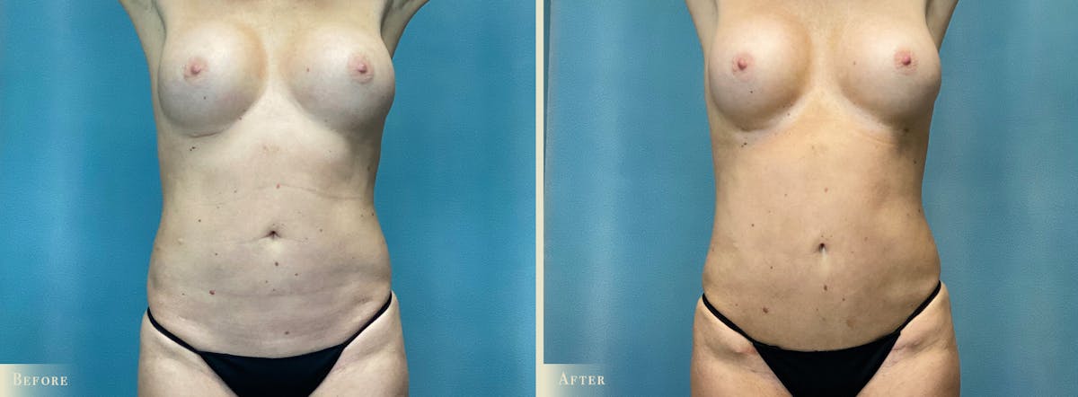Mini Tummy Tuck Before & After Gallery - Patient 123665 - Image 1