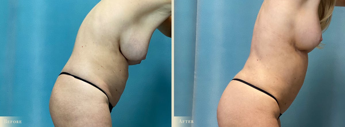 Mini Tummy Tuck Before & After Gallery - Patient 123665 - Image 3