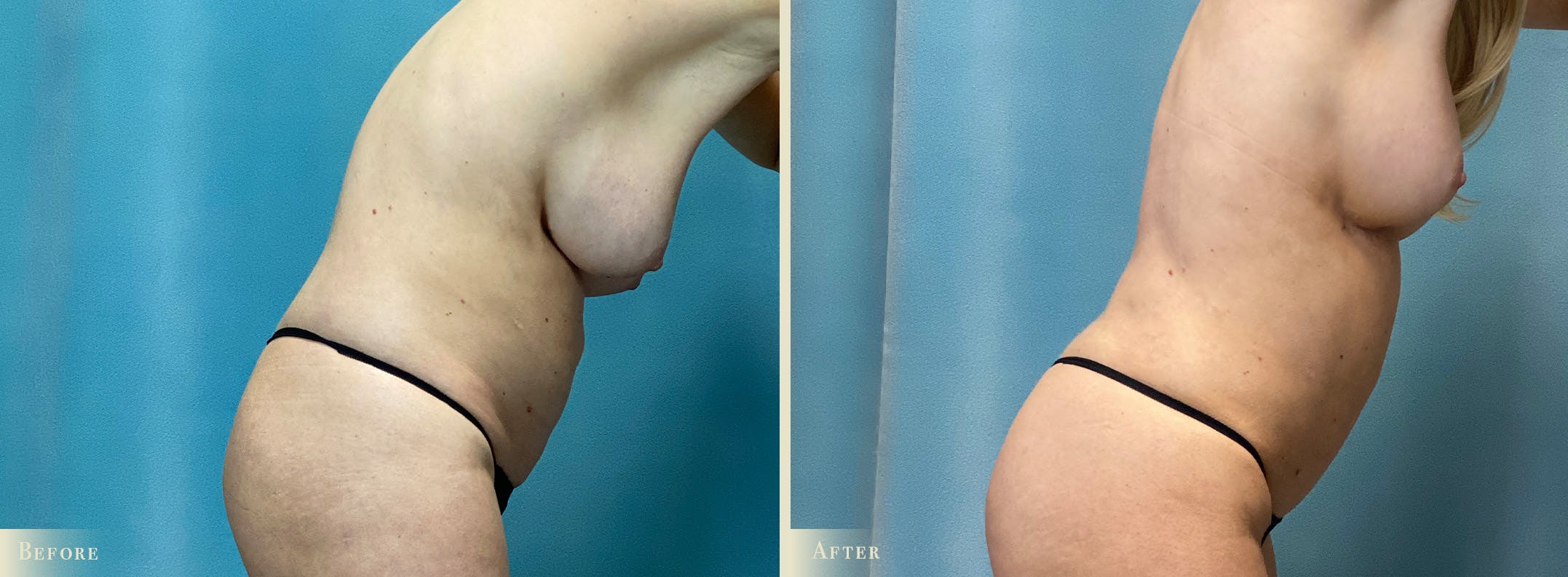Female Liposuction Before & After Gallery - Patient 145577 - Image 3