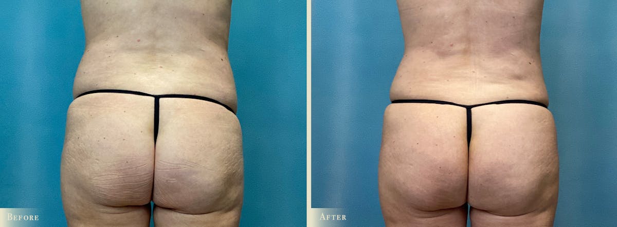 Mini Tummy Tuck Before & After Gallery - Patient 123665 - Image 4