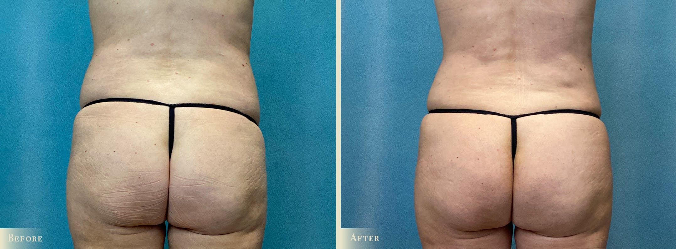 Female Liposuction Before & After Gallery - Patient 145577 - Image 4