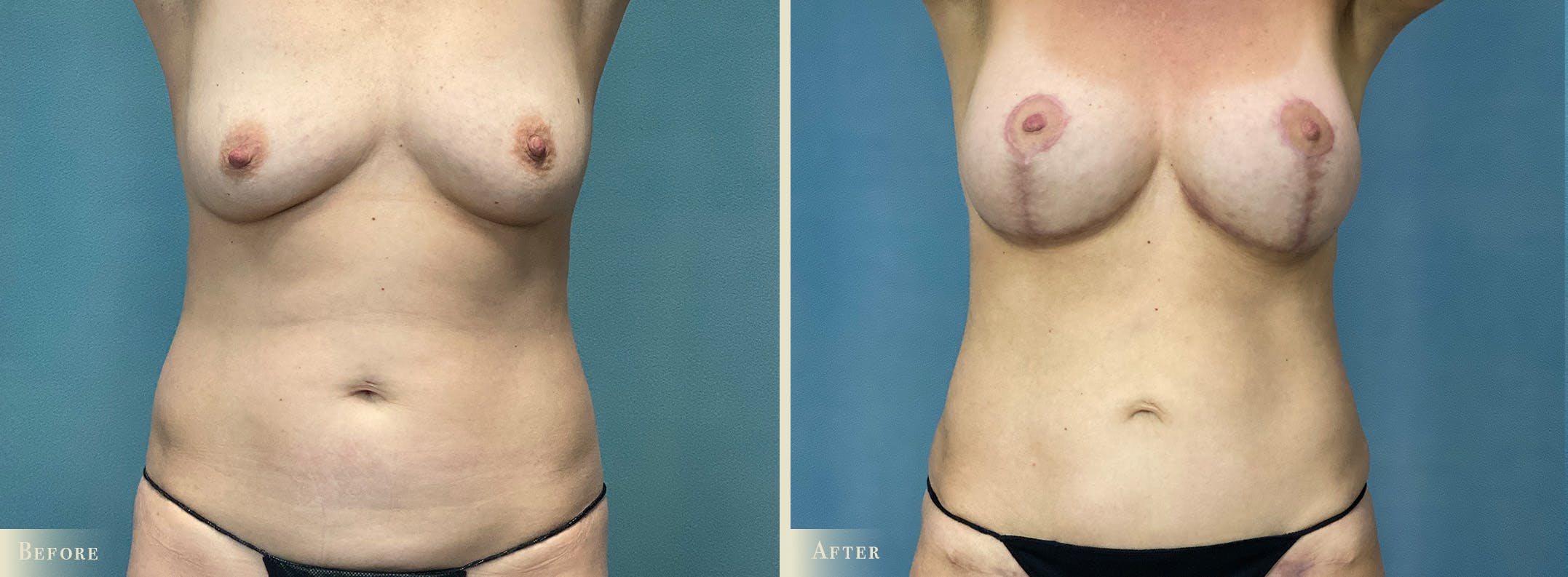 Mini Tummy Tuck Before & After Gallery - Patient 265681 - Image 1