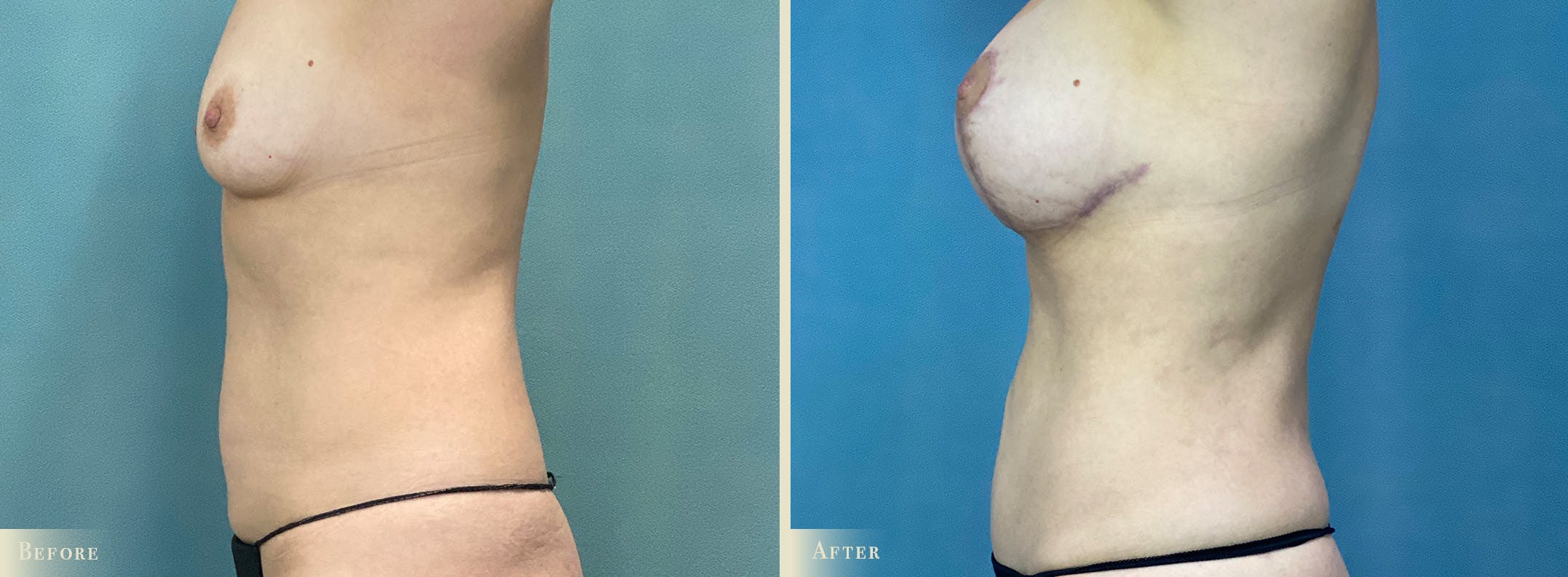 Mini Tummy Tuck Before & After Gallery - Patient 265681 - Image 2