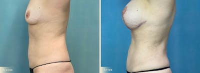 Mini Tummy Tuck Before & After Gallery - Patient 265681 - Image 2