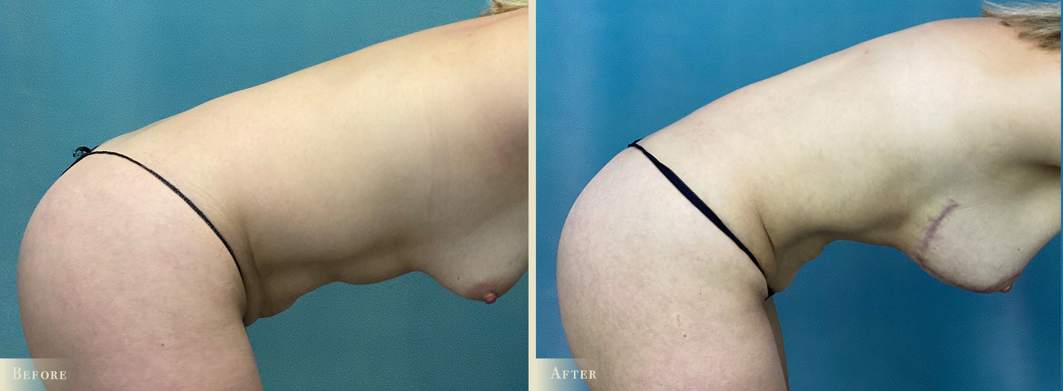 Mini Tummy Tuck Before & After Gallery - Patient 265681 - Image 3