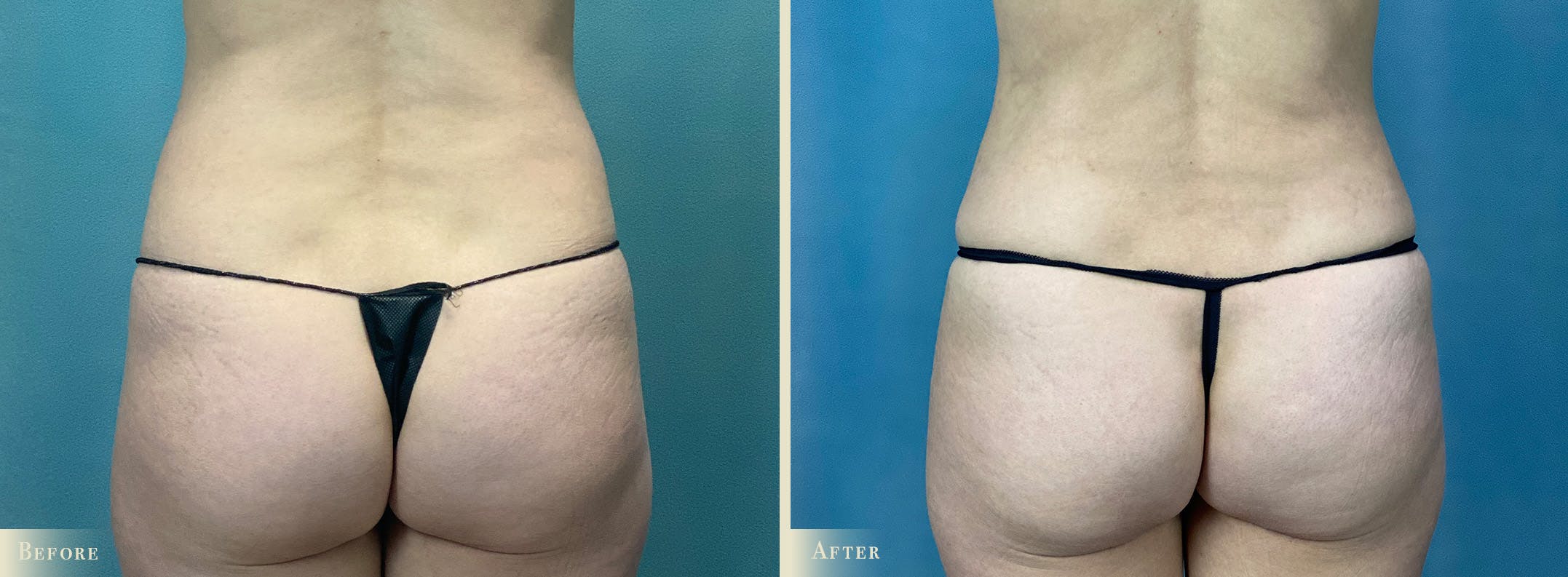Mini Tummy Tuck Before & After Gallery - Patient 265681 - Image 4