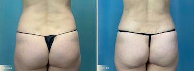 Mini Tummy Tuck Before & After Gallery - Patient 265681 - Image 4