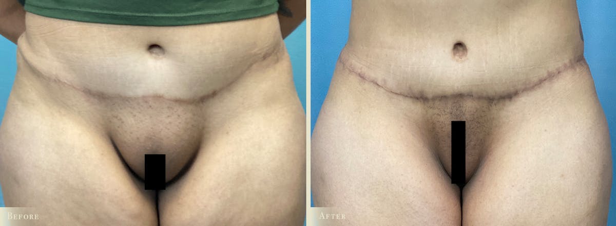 Mini Tummy Tuck Before & After Gallery - Patient 319701 - Image 1