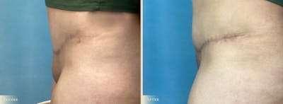 Mini Tummy Tuck Before & After Gallery - Patient 319701 - Image 2
