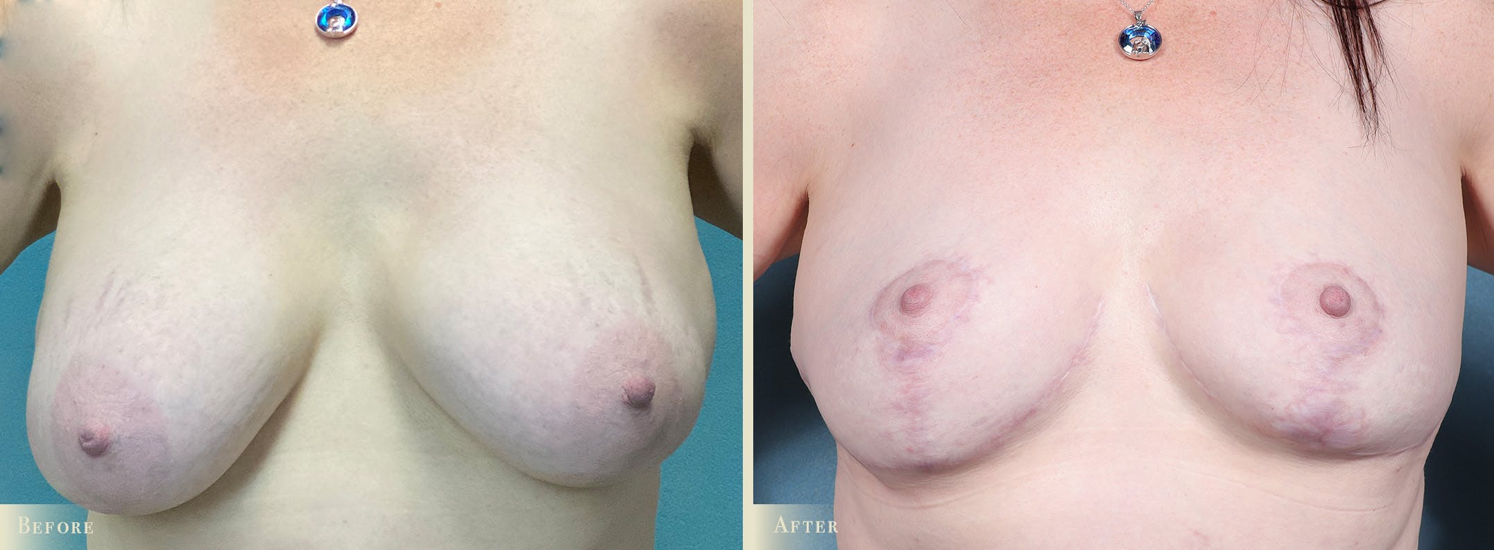 Explant with Lift Before & After Gallery - Patient 181568 - Image 1