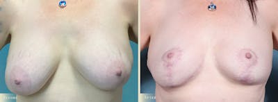 Explant with Lift Before & After Gallery - Patient 181568 - Image 1