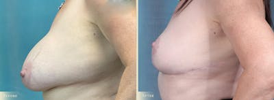 Explant with Lift Before & After Gallery - Patient 181568 - Image 3