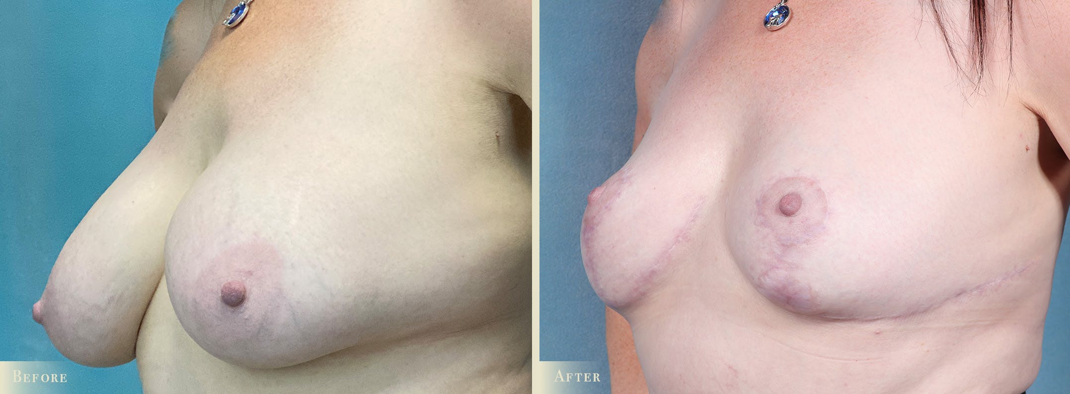 Explant with Lift Before & After Gallery - Patient 181568 - Image 2