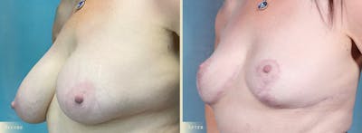 Explant with Lift Before & After Gallery - Patient 181568 - Image 2