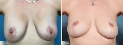 Explant with Lift Before & After Gallery - Patient 218508 - Image 1
