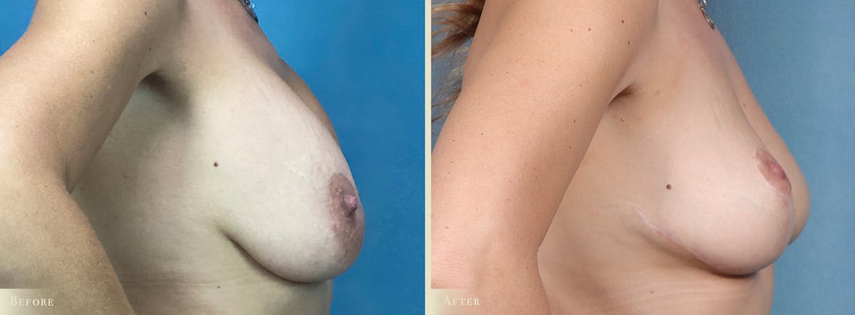 Explant with Lift Before & After Gallery - Patient 218508 - Image 3