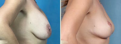 Explant with Lift Before & After Gallery - Patient 218508 - Image 3