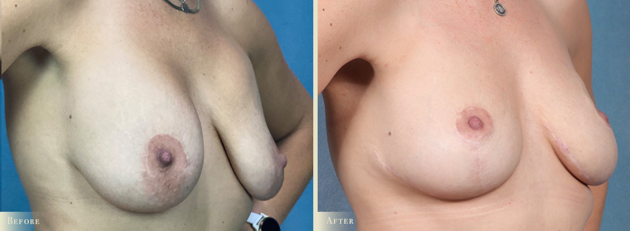 Explant with Lift Before & After Gallery - Patient 218508 - Image 2