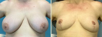 Explant with Lift Before & After Gallery - Patient 165217 - Image 1