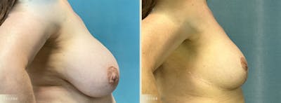 Explant with Lift Before & After Gallery - Patient 165217 - Image 3