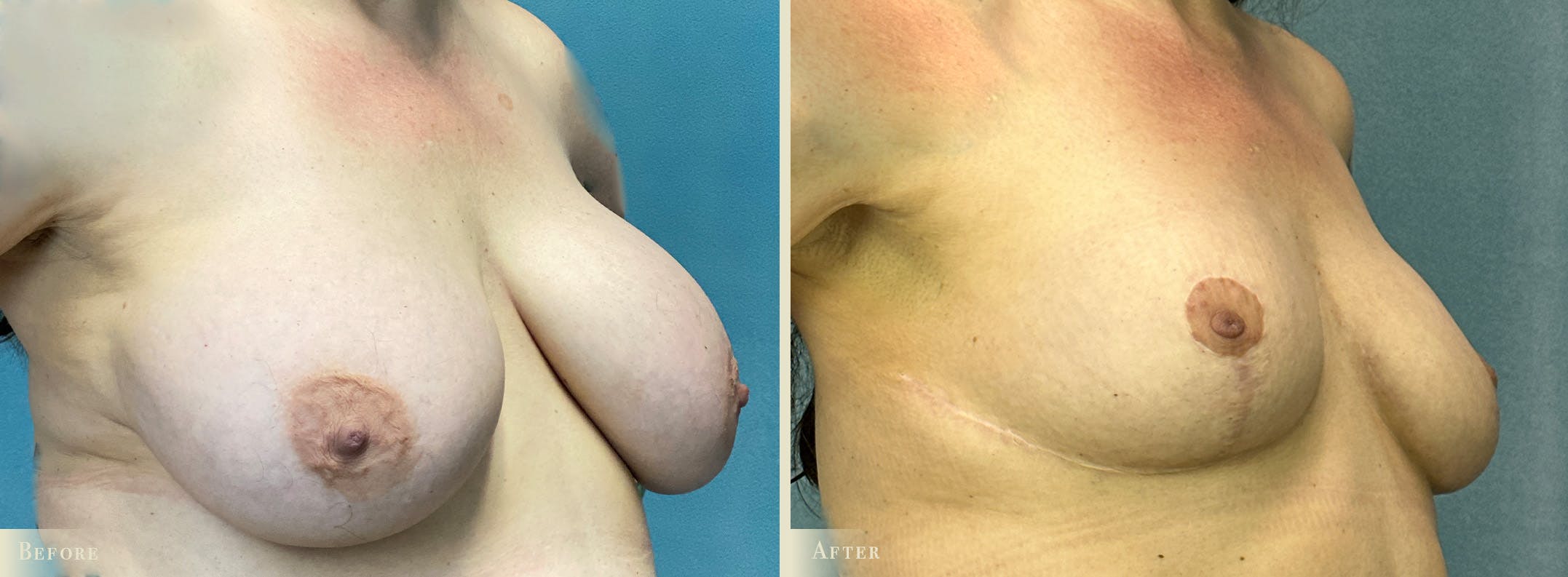Explant with Lift Before & After Gallery - Patient 165217 - Image 2