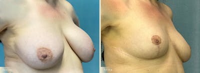 Explant with Lift Before & After Gallery - Patient 165217 - Image 2