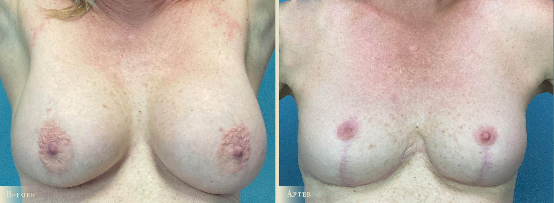 Explant with Lift Before & After Gallery - Patient 102954 - Image 1