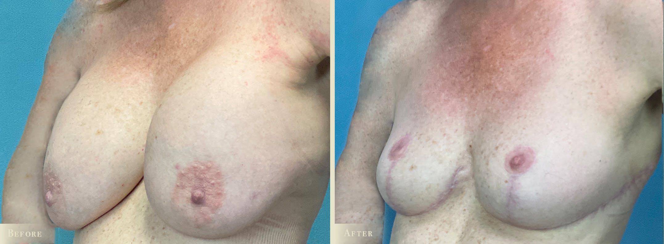 Explant with Lift Before & After Gallery - Patient 102954 - Image 2