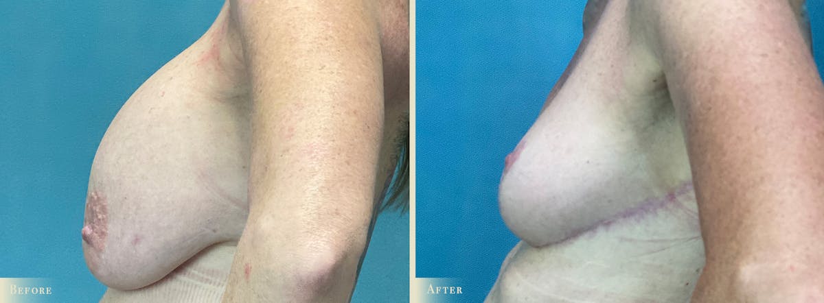 Explant with Lift Before & After Gallery - Patient 102954 - Image 3