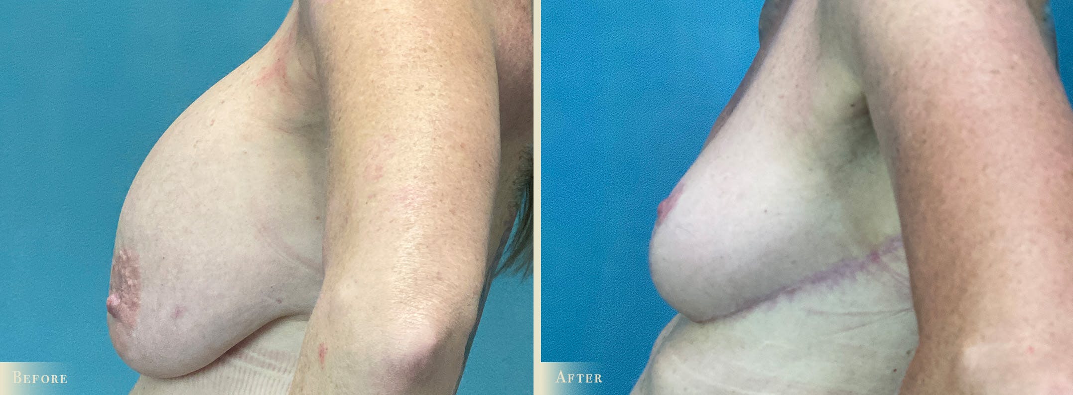 Explant with Lift Before & After Gallery - Patient 102954 - Image 3