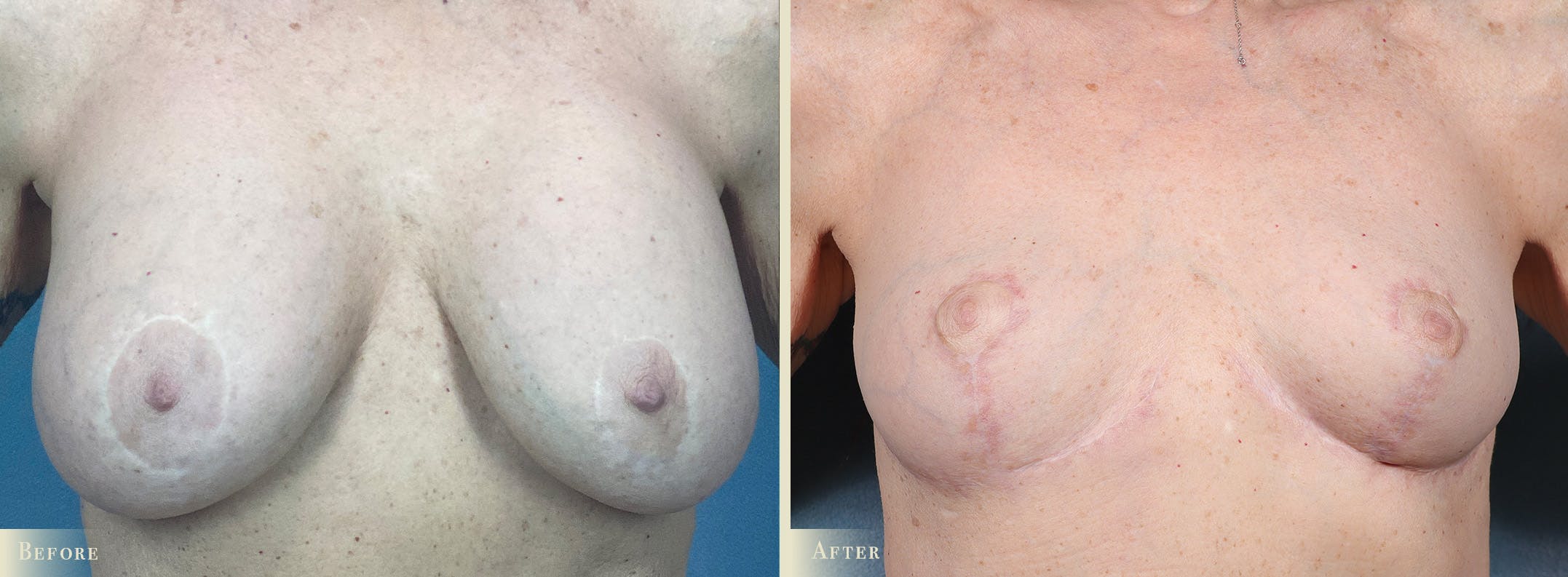Explant with Lift Before & After Gallery - Patient 928047 - Image 1