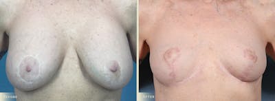 Explant with Lift Before & After Gallery - Patient 928047 - Image 1