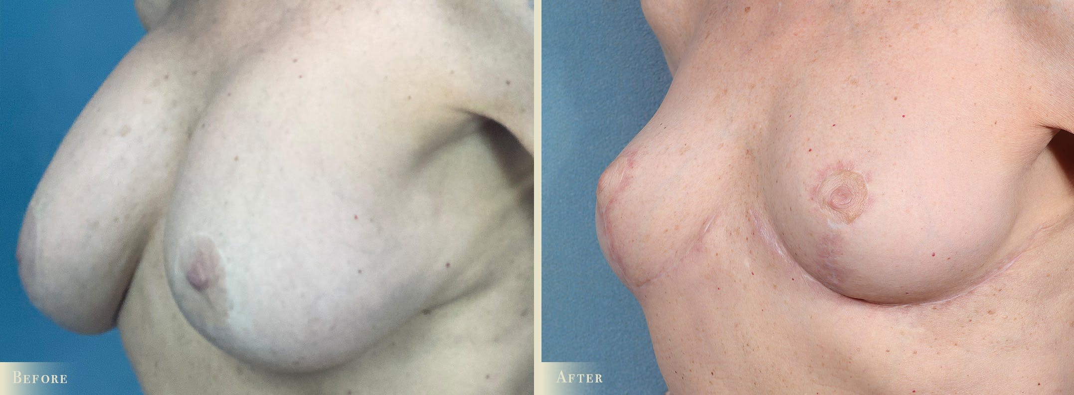 Explant with Lift Before & After Gallery - Patient 928047 - Image 2