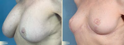 Explant with Lift Before & After Gallery - Patient 928047 - Image 2