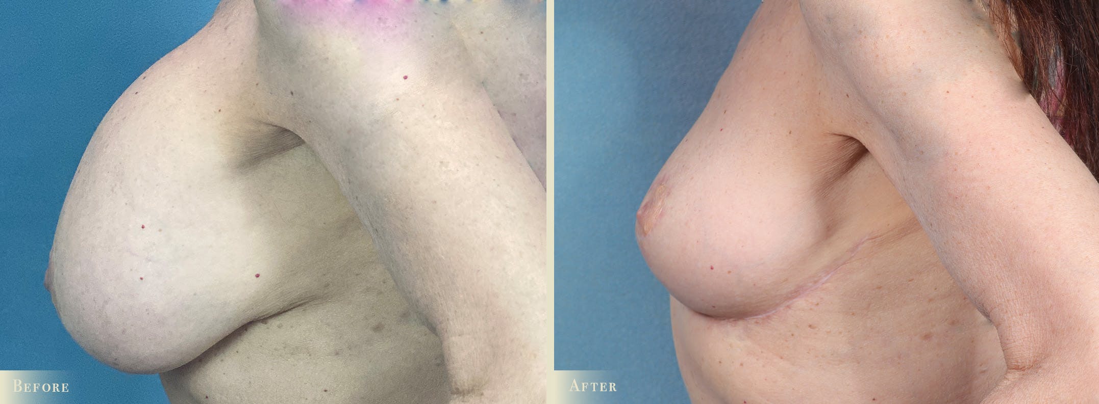 Explant with Lift Before & After Gallery - Patient 928047 - Image 3