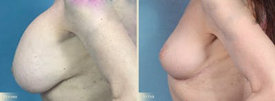 Explant with Lift Before & After Gallery - Patient 928047 - Image 3