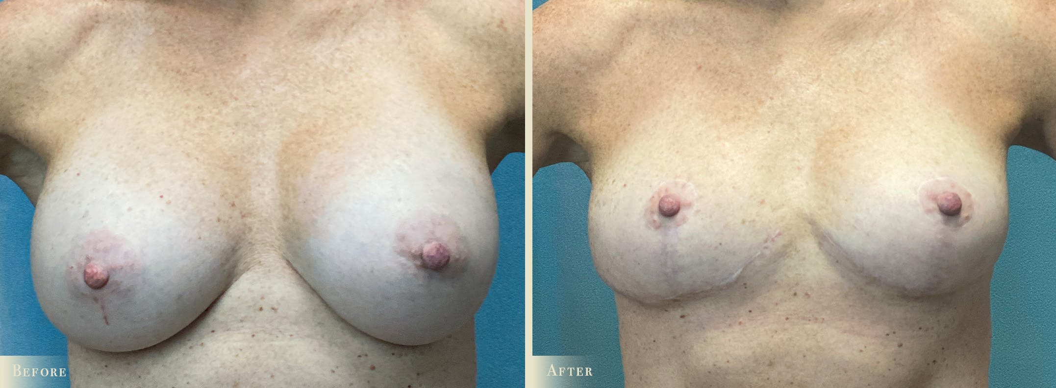 Explant with Lift Before & After Gallery - Patient 401541 - Image 1