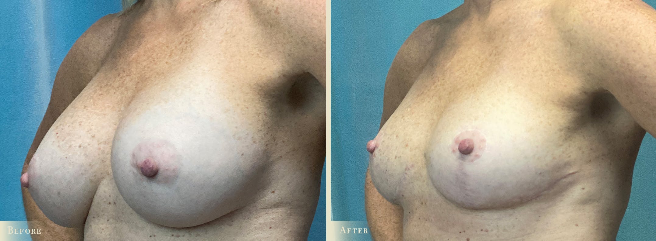 Explant with Lift Before & After Gallery - Patient 401541 - Image 2