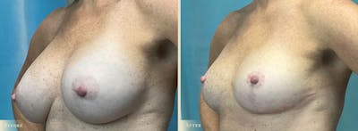 Explant with Lift Before & After Gallery - Patient 401541 - Image 2