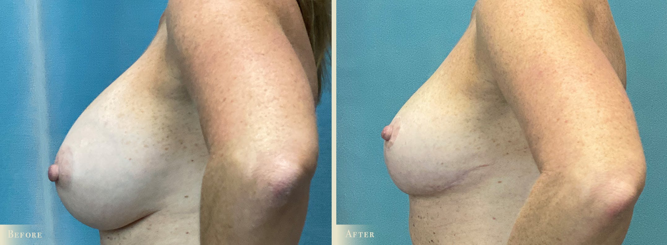 Explant with Lift Before & After Gallery - Patient 401541 - Image 3