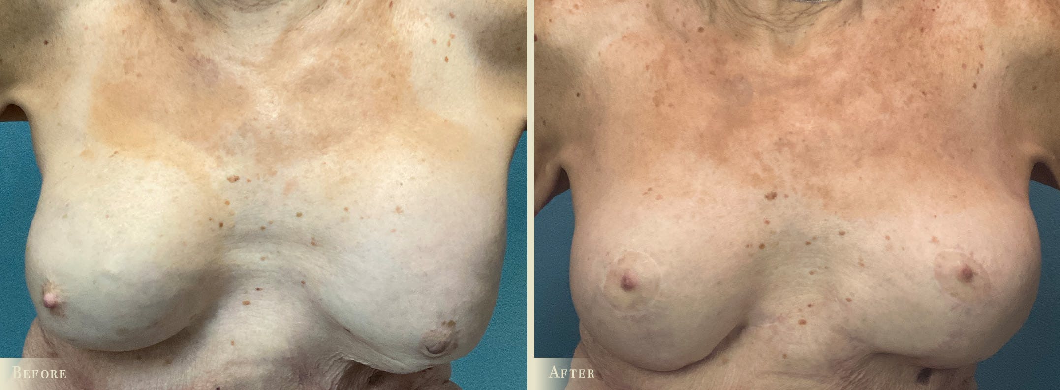 Breast Implant Revision/Replacement Before & After Gallery - Patient 382543 - Image 1