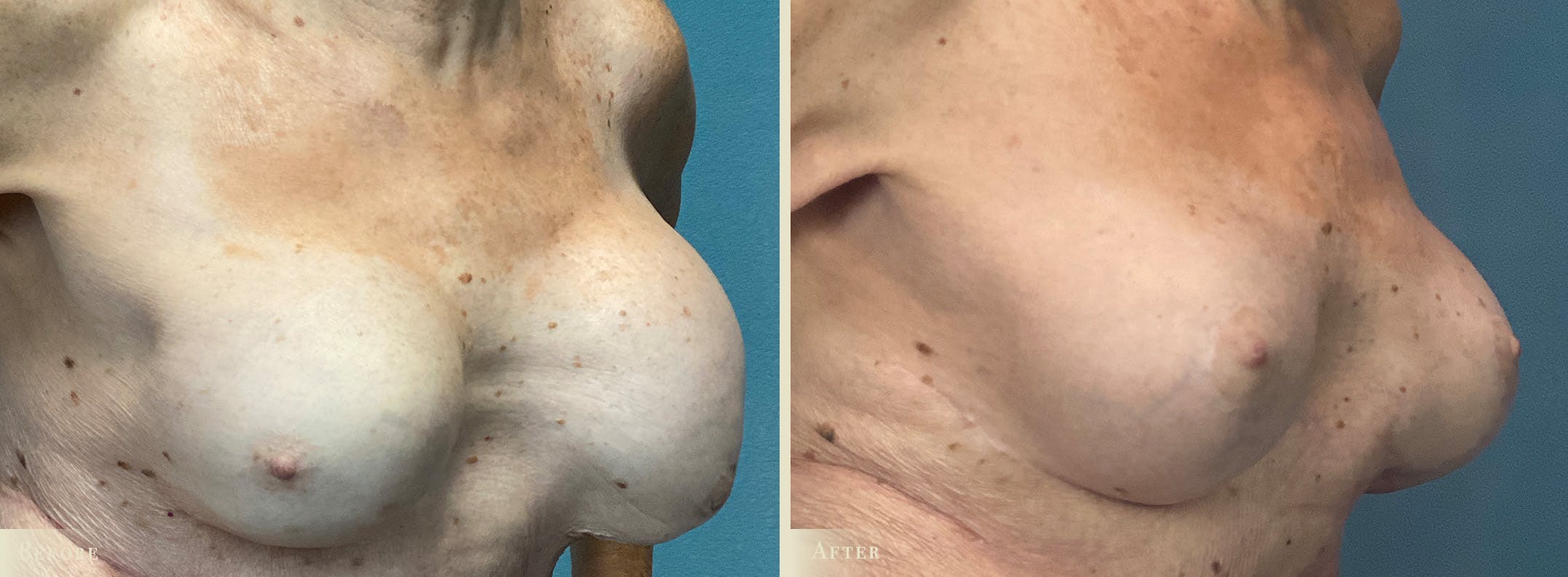 Breast Implant Revision/Replacement Before & After Gallery - Patient 382543 - Image 2