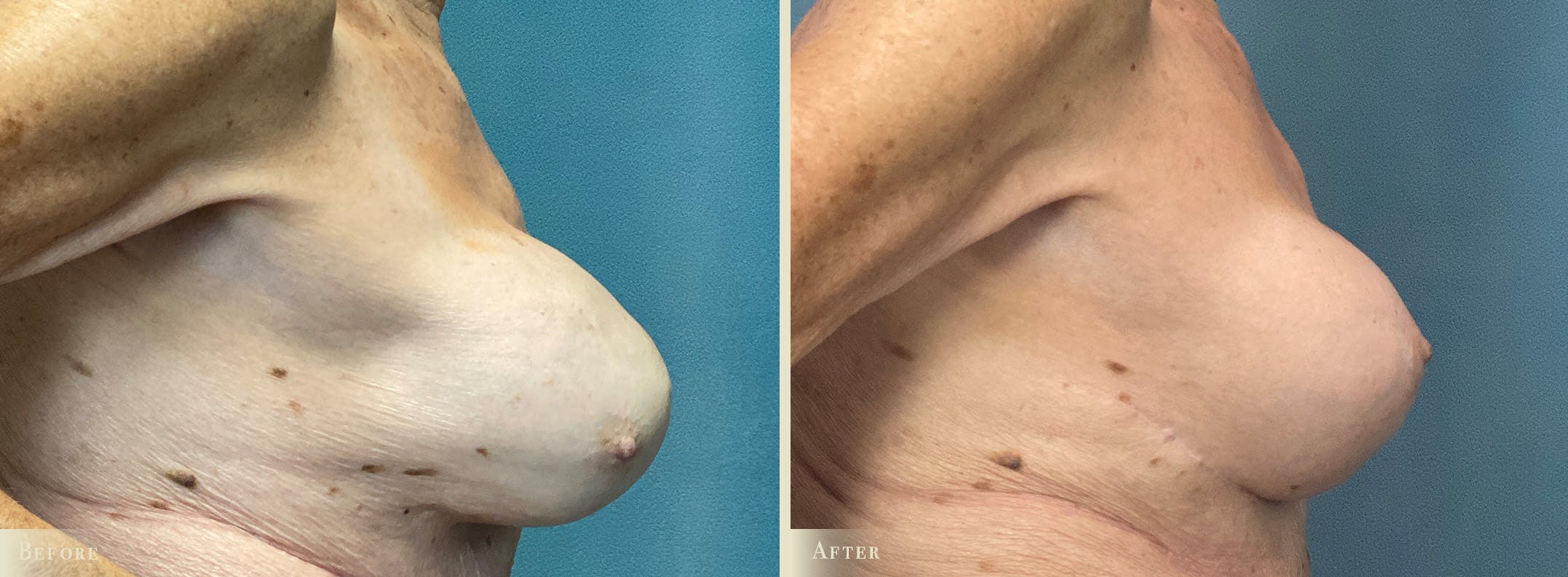 Breast Implant Revision/Replacement Before & After Gallery - Patient 382543 - Image 3