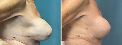 Breast Implant Revision/Replacement Before & After Gallery - Patient 382543 - Image 3