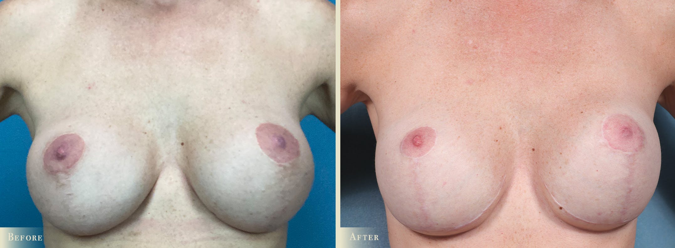 Breast Implant Revision/Replacement Before & After Gallery - Patient 639488 - Image 1